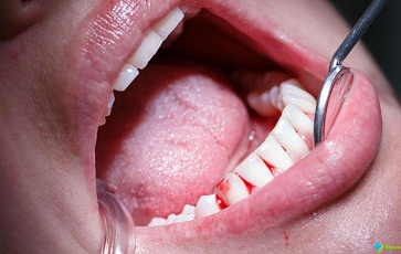 Лечение зубов катушками Мишина