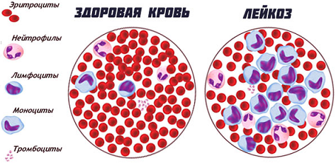 лимфолейкоз, болезнь крови - лечение катушками Мишина