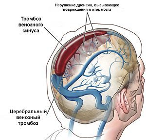 Тромбоз венозного синуса головного мозга - лечение катушками Мишина